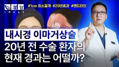 내시경이마거상술 안면거상술  성형외과 추천