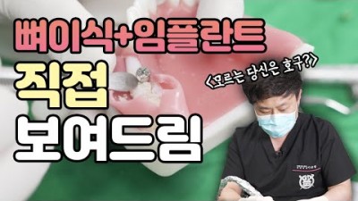 뼈이식 임플란트 치과 비용 임플란트종류 임플란트가격 및 소개