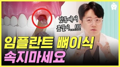 임플란트 뼈이식 치과치료 비용차이 임플란트 가격 소개