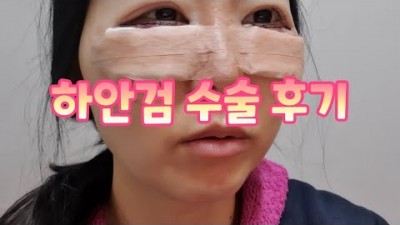 성형외과 성형수술 하안검 수술 후기, 눈밑지방제거, 수술 부작용, 결막부종