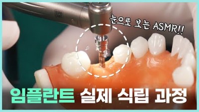 임플란트 수술 과정 임플란트 종류와 임플란트 심는 전 과정 설명