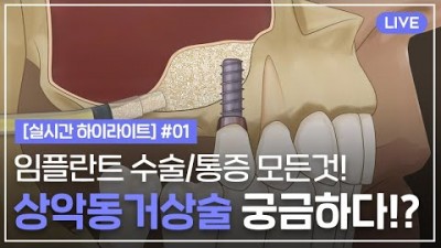임플란트 상악동거상술 수술과정 잇몸통증 과정 알아보기